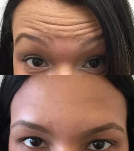 botox before and after