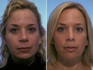 botox before and after