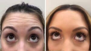 botox before and after